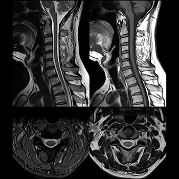 Cervical Spine imaging